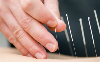 Acupuncture