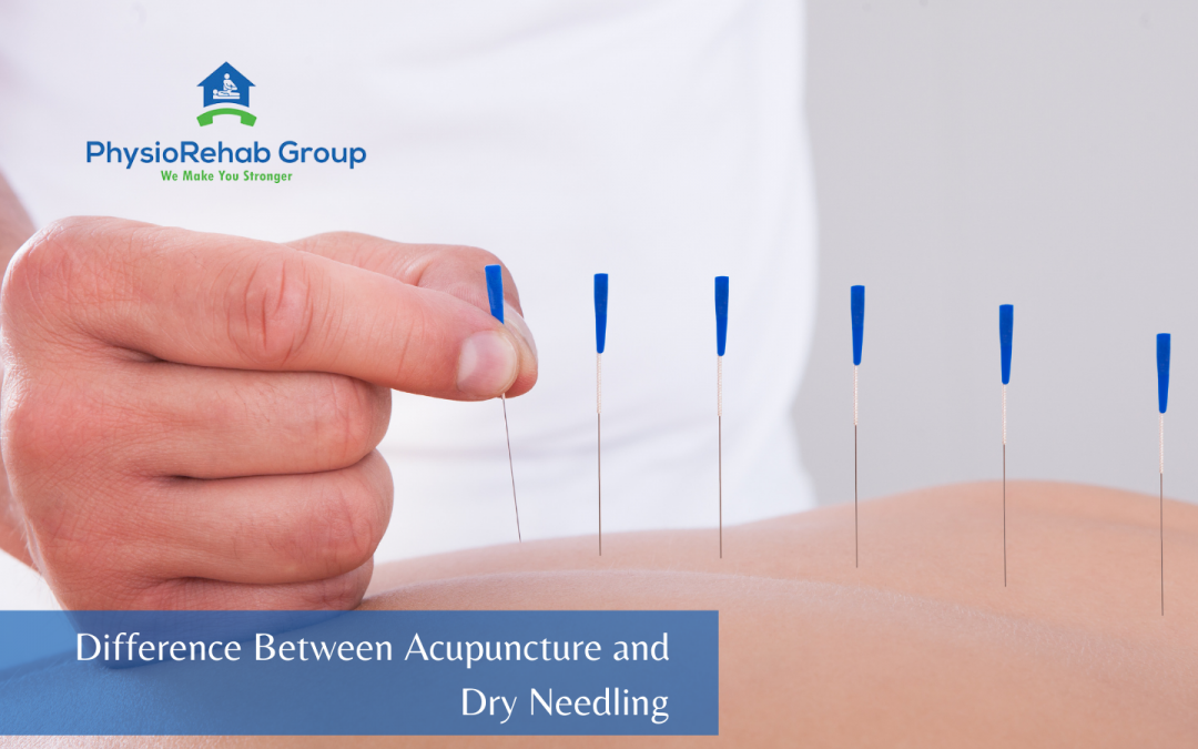 Difference Between Acupuncture and Dry Needling